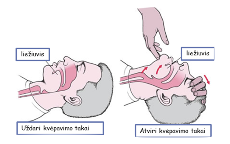 Atverkite kvėpavimo takus