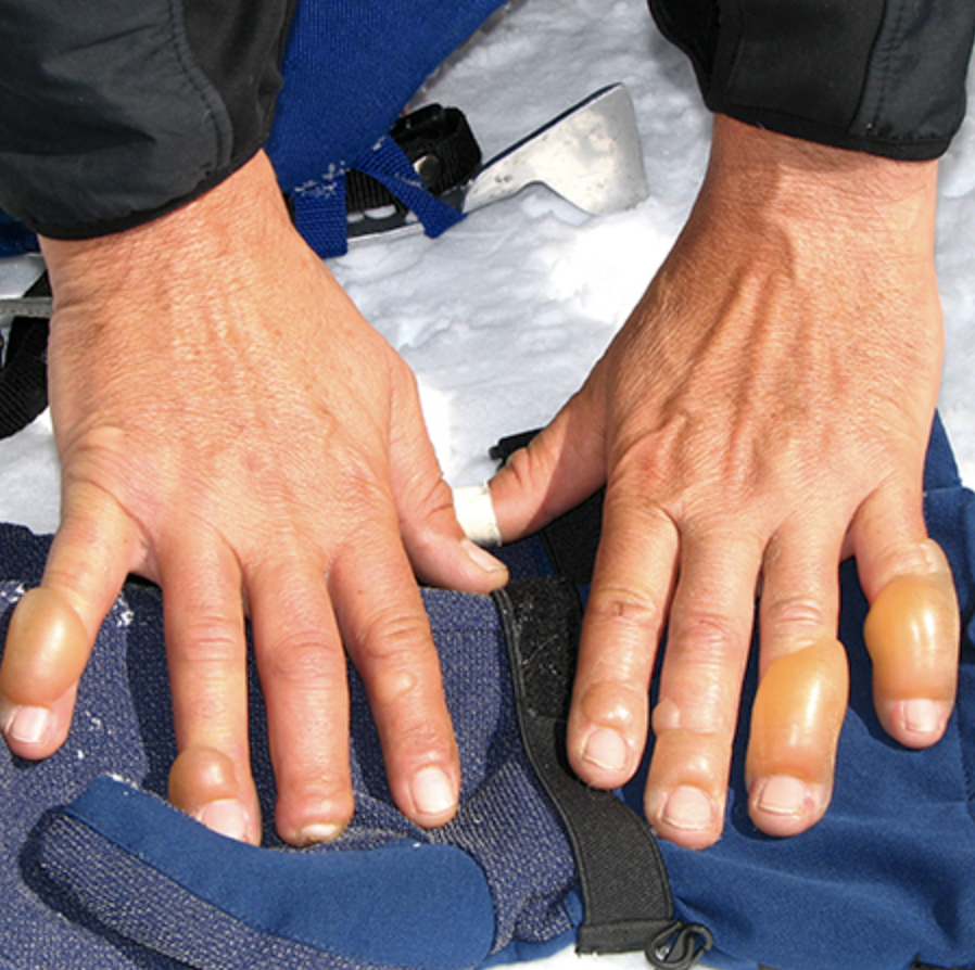 I laipsnio nušalimas